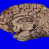 3B1 MS, Periventricular Plaque (Case 3) H&E whole mount_1 copyA