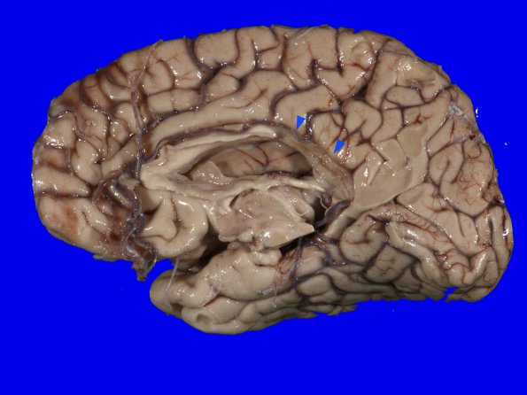 3B1 MS, Periventricular Plaque (Case 3) H&E whole mount_1 copyA