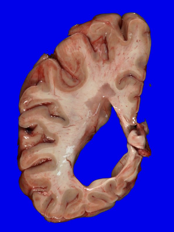 3B2 MS, cortical plaques (Case 3) Gross 7A