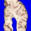 3B4 MS, Periventricular Plaque (Case 3) H&E whole mount_3A