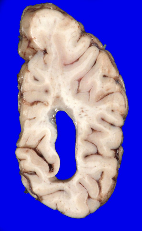 3B4 MS, Periventricular Plaque (Case 3) H&E whole mount_3A