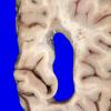 3B5 MS, Periventricular Plaque (Case 3) H&E whole mount_4A