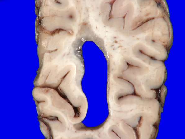 3B5 MS, Periventricular Plaque (Case 3) H&E whole mount_4A