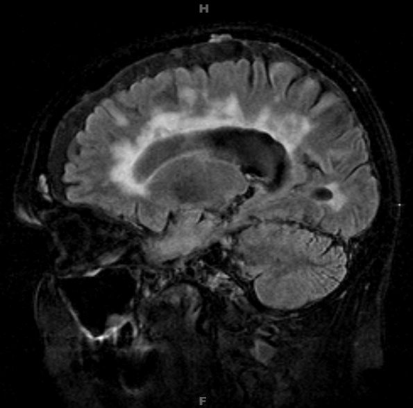 5A1 MS (Case 5) T2 FLAIR no contrast 1 - Copy
