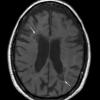 5A2 MS (Case 5) T1 no contrast 1 - Copy copy