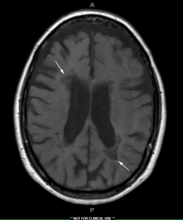 5A2 MS (Case 5) T1 no contrast 1 - Copy copy