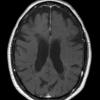 5A3 MS (Case 5) T1 with contrast 1 - Copy