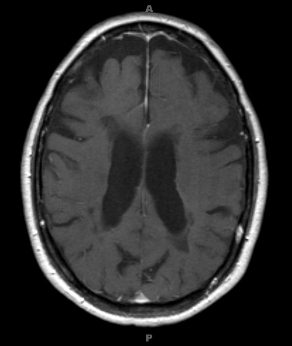 5A3 MS (Case 5) T1 with contrast 1 - Copy