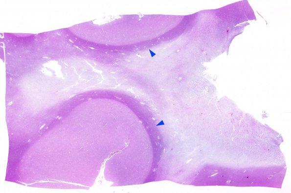 5D1 Multiple sclerosis (MS, Case 5) N13 NF WM copy