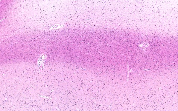 5D2 Multiple sclerosis (MS, Case 5) N5 4X