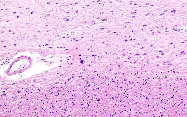 5D3 Multiple sclerosis (MS, Case 5) N5 20X