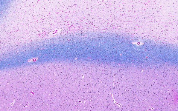 5D4 Multiple sclerosis (MS, Case 5) N5 LFB-PAS 4X