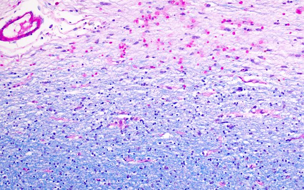 5D5 Multiple sclerosis (MS, Case 5) N5 LFB-PAS 20X