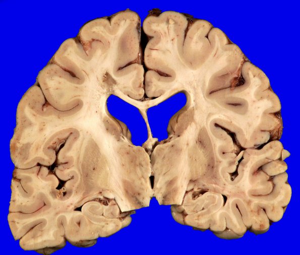 6A1 MS (Case 6)_5A