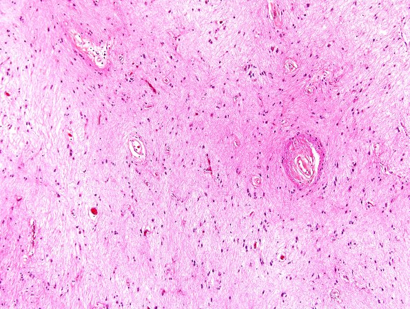 6B4 MS (Case 6) N11 Area E H&E 10X