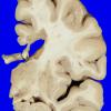 7A1 Multiple Sclerosis (Case 7) 10A