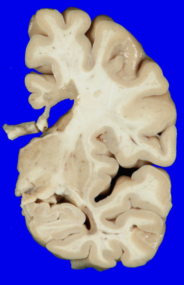 7A1 Multiple Sclerosis (Case 7) 10A