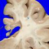 7A2 MS, cortical plaque (Case 7) gross 3 copy
