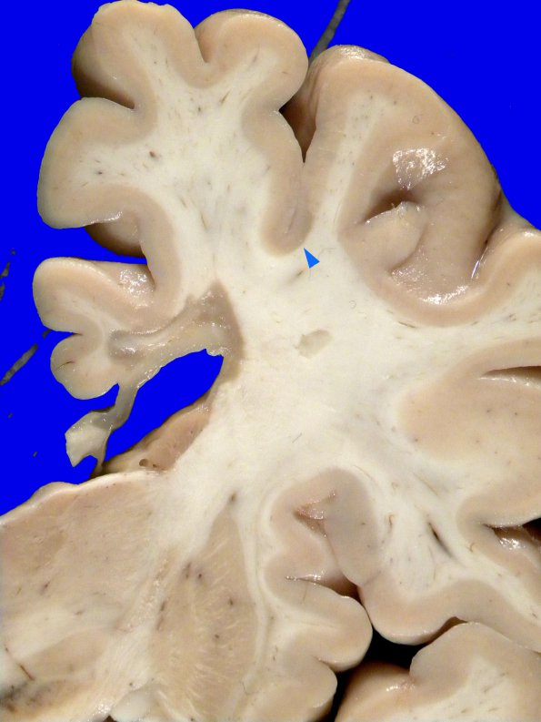 7A2 MS, cortical plaque (Case 7) gross 3 copy