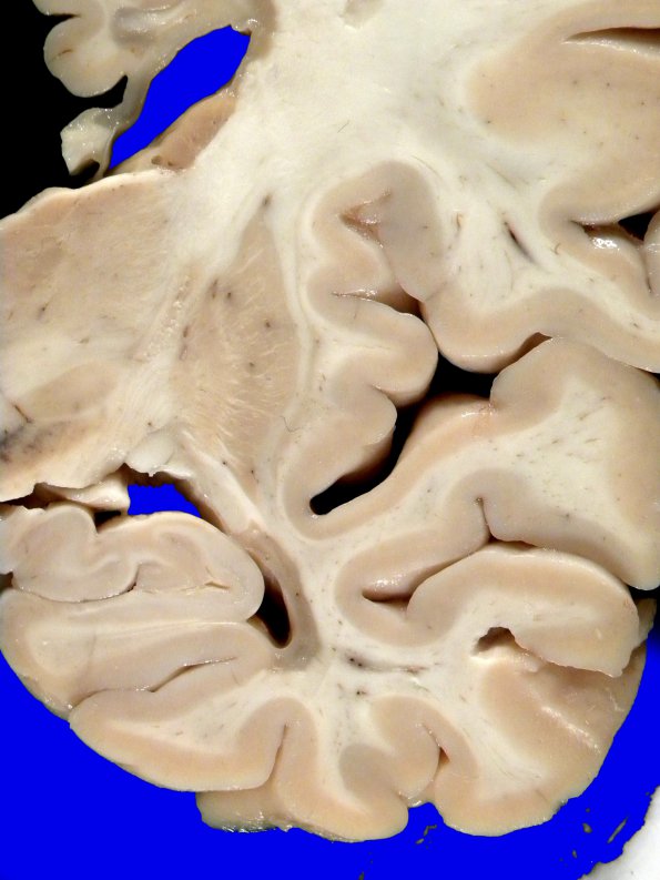 7A3 MS, cortical plaque (Case 7) gross 2A