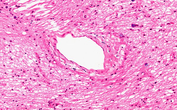 7B2 MS Plaque (Case 7) N8 H&E 20X