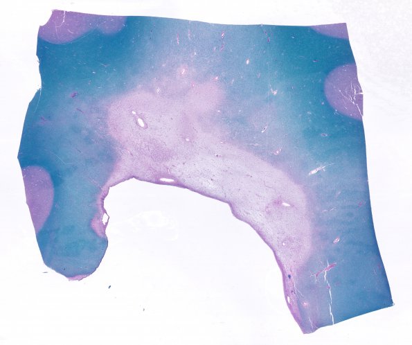 7B3 MS Plaque (Case 7) whole mount plaque Correlate with N8 LFB-PAS 1