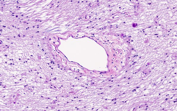 7B4 MS Plaque (Case 7) N8 LFB-PAS 20X