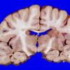 8A1 Multiple Sclerosis (Case 8) 4A