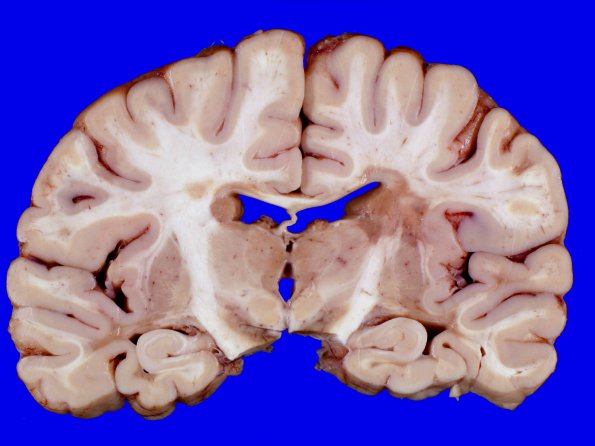 8A1 Multiple Sclerosis (Case 8) 4A