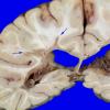 8A2 Multiple Sclerosis (Case 8) 6 copyA