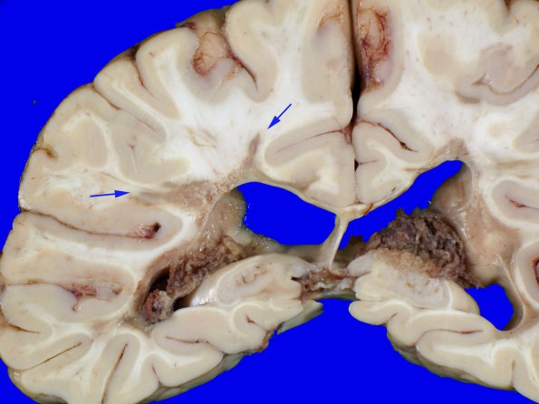 8A2 Multiple Sclerosis (Case 8) 6 copyA