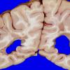 8A3 Multiple Sclerosis (Case 8) 5A