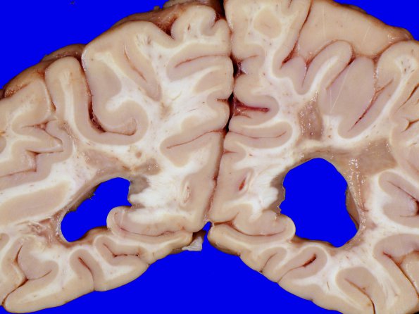 8A3 Multiple Sclerosis (Case 8) 5A