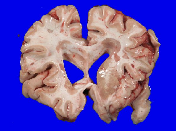 9A1 Multiple Sclerosis (Case 9) 1A