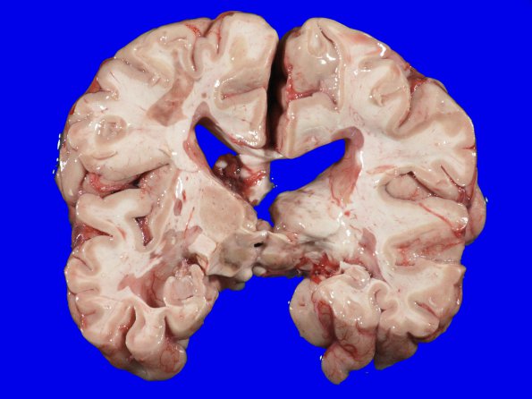 9A2 Multiple Sclerosis (Case 9) 2A