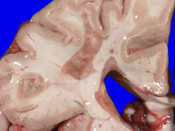 9A3 Multiple Sclerosis (Case 9) 4A