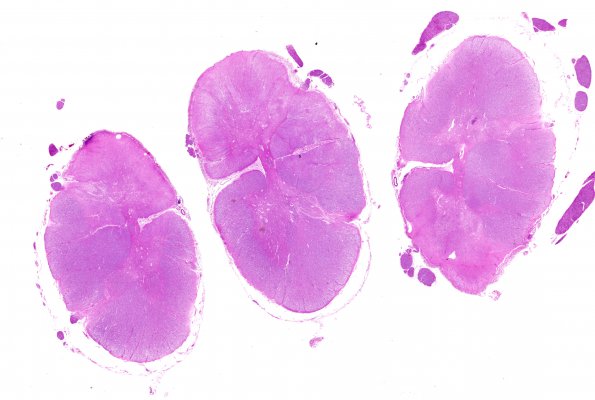 1C1 MS (Case 1) N10 H&E WM