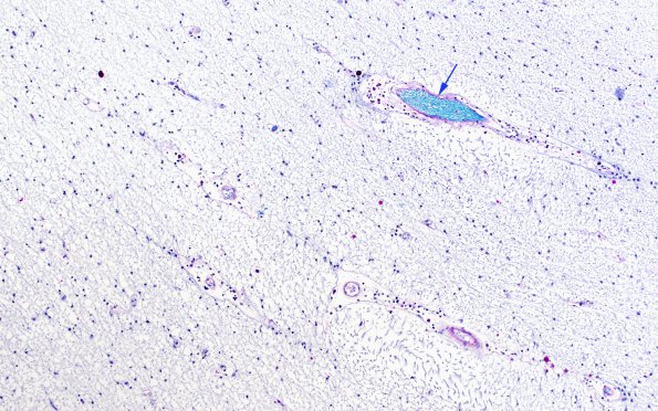 1D10 MS, chronic active (Case 1) N5 Burned-out area LFB-PAS 10X copy