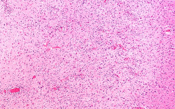 1D5 MS, chronic active (Case 1) N5 Inflamed area H&E 10X