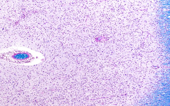 1D6 MS, chronic active (Case 1) N5 Inflamed area LFB-PAS 10X