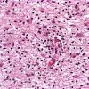 1D7 Multiple Sclerosis (Case 1) Chronic Active MS, H&E active area (2)