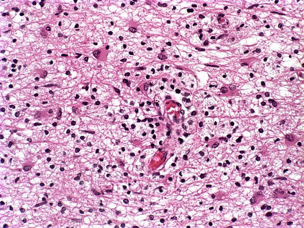 1D7 Multiple Sclerosis (Case 1) Chronic Active MS, H&E active area (2)