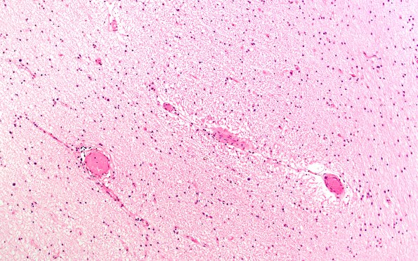 1D8 MS, chronic active (Case 1) N5 Burned-out area H&E 10X