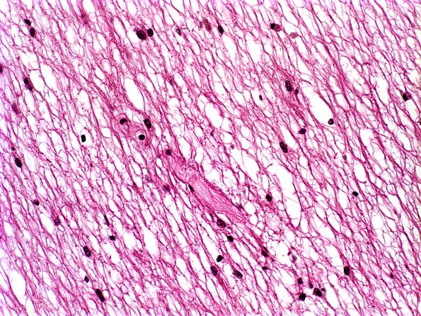 1D9 Multiple Sclerosis (Case 1) Chronic Active MS, H&E old area (2)