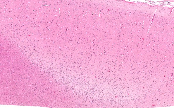 1E1 MS, chronic active (Case 1) N1 H&E 4X