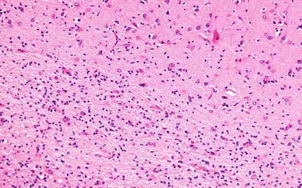 1E2 MS, chronic active (Case 1) N1 H&E 20X