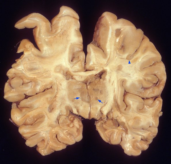 2A1 MS, chronic active (Case 2) A5 copy