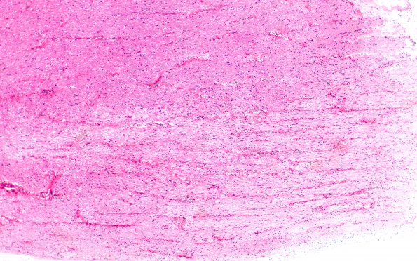 2B1 MS, (Case 2) N12 optic nerve H&E 4X