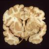 2C1 Multiple Sclerosis, (Case 2) Chronic Active Plaque  1 - Copy copy