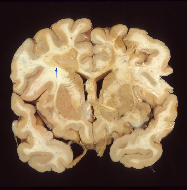 2C1 Multiple Sclerosis, (Case 2) Chronic Active Plaque  1 - Copy copy